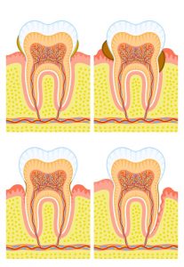 T32 Dental Gum Treatment - graphics of a gum