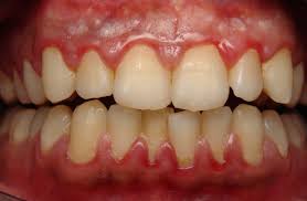 gum swelling