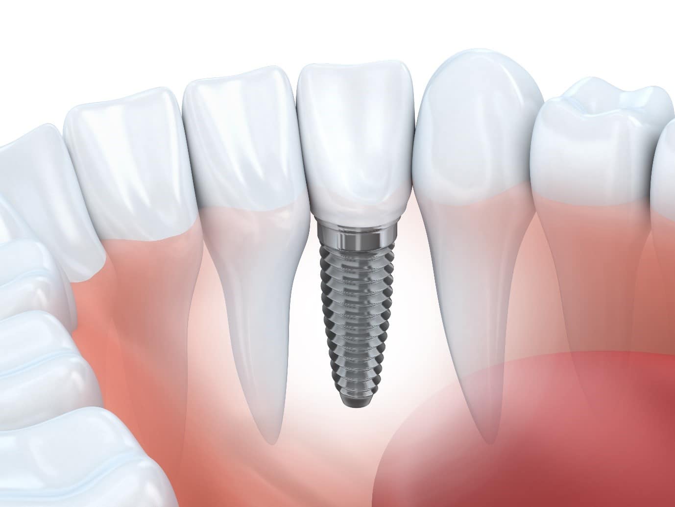 T32 Dental Replace your missing teeth with dental implants