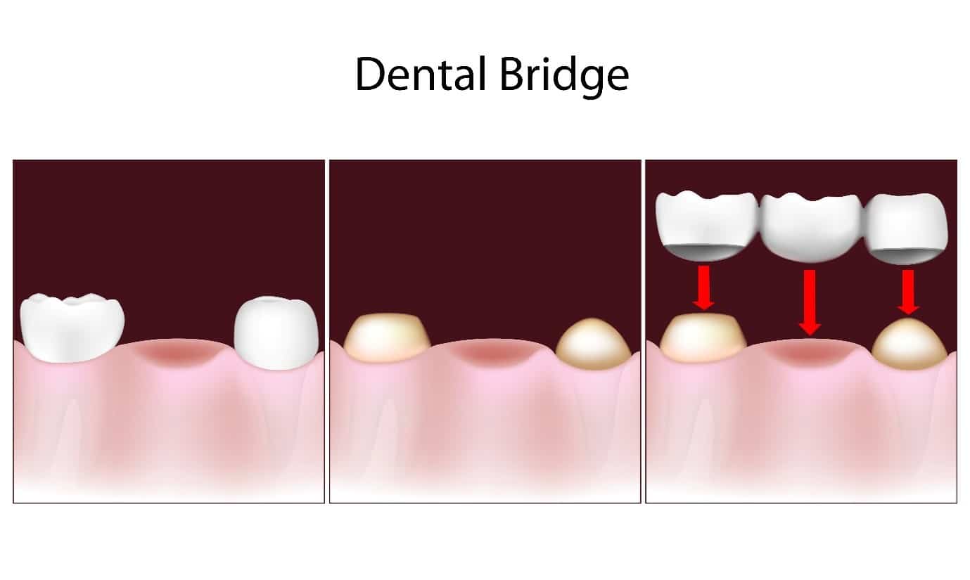 T32 Dental Replace Your Missing Teeth With Denture Bridge