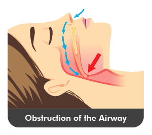 T32 Sleep Apnea - Airway Obstruction (Graphics)