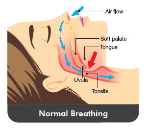 T32 Sleep Apnea - Normal Breathing (Graphics)