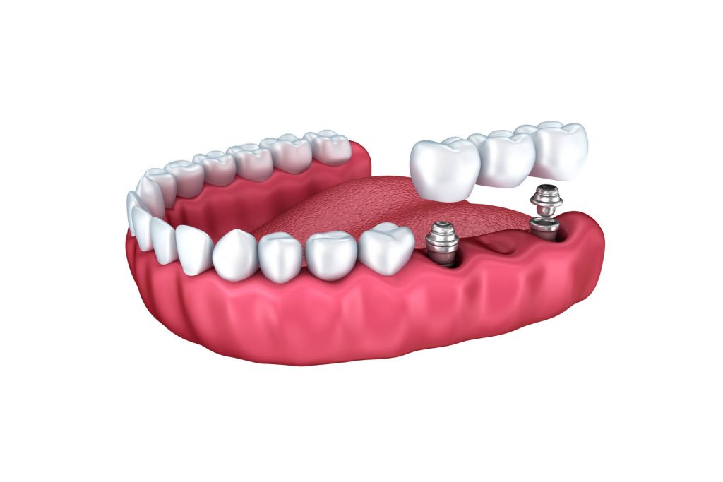 dental implants crowns and pins