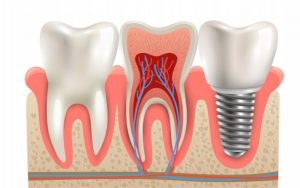 Visual illustration of Dental Implants